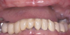Dental Implants Before & After