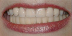 Restorations Before and After Photos