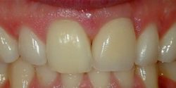 Restorations Before and After Photos