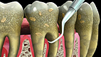 Dental scaling and root planing procedure removing tartar from teeth.