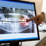 Mounth X-ray in with finger pointing